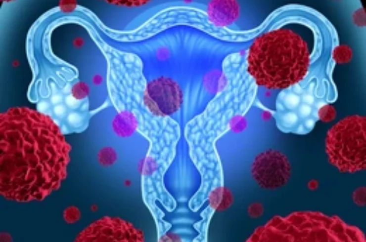 Cervical Cancer