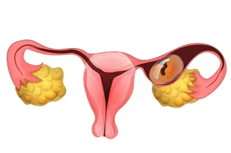 Ectopic Pregnancy